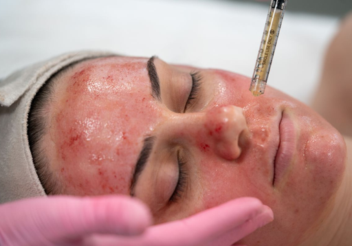 Vampire Facial PRP